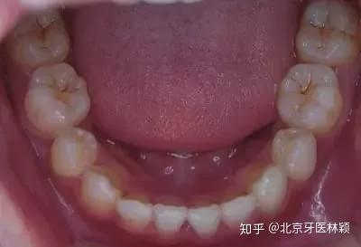 第二阶段:牙本质腐蚀,龋坏进一步加深,形成龋洞