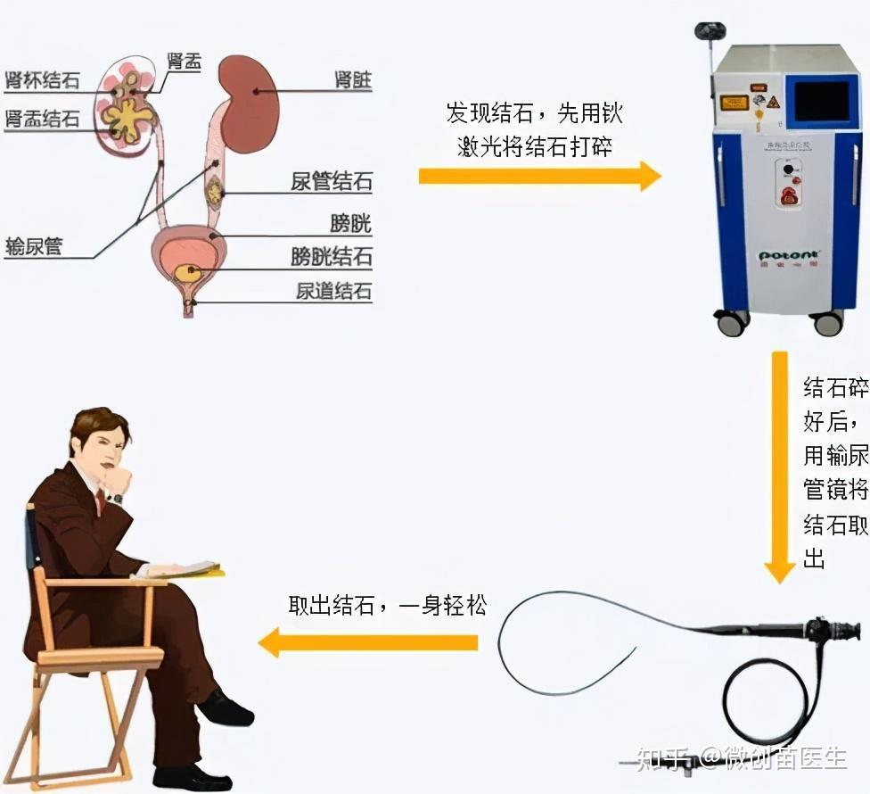 秋季肾结石高发这段石头虐恋到底有多疼