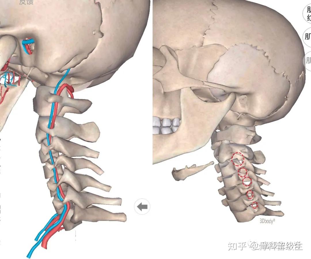 颈椎失稳后,椎体间形成了前后向错位,此时穿行于椎体横突孔的椎动脉极