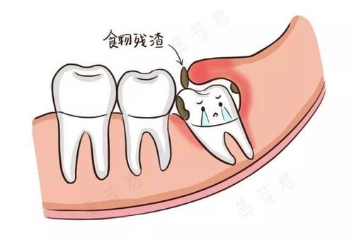 原因:阻生智齿和牙龈形成的盲袋堆积的食物残渣过多从而引发炎症(点此