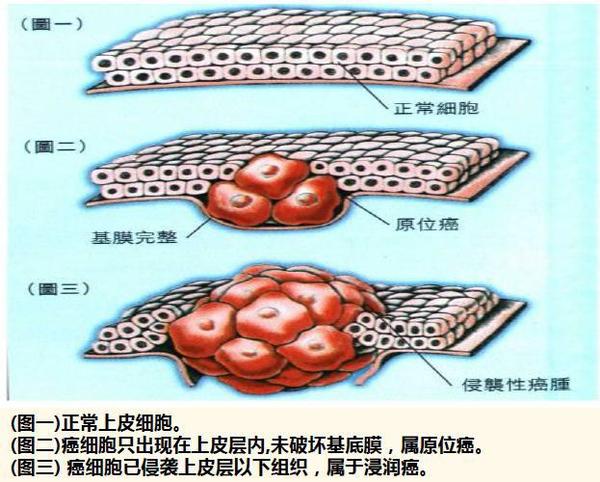 国内保险原位癌 得了 原位癌 能不能买重疾