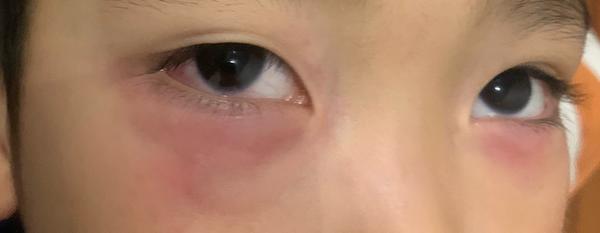 小孩眼睛红肿 ,过敏性结膜炎怎么办?