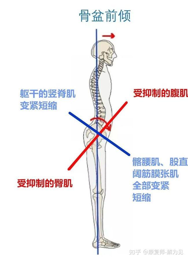 小于这个厚度则为骨盆后倾,大于这个厚度,则为骨盆前倾