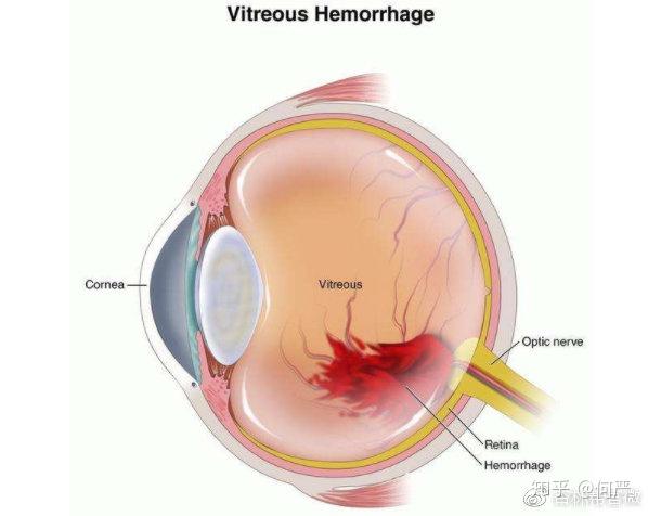 毕燕龙教授告诉你玻璃体出血可能并不简单