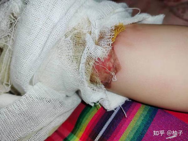 手腕伤的重