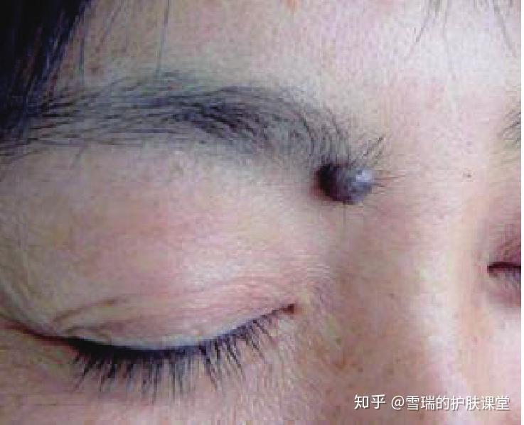 身上的痣是单纯的色素痣还是病变教你识别技巧