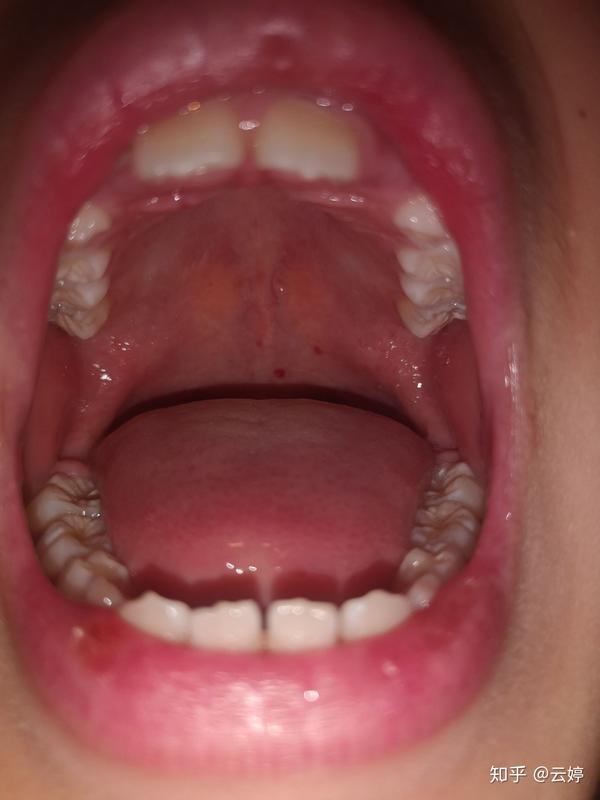 八岁孩子发烧以后口腔里面有红斑,是疱疹性咽颊炎吗?