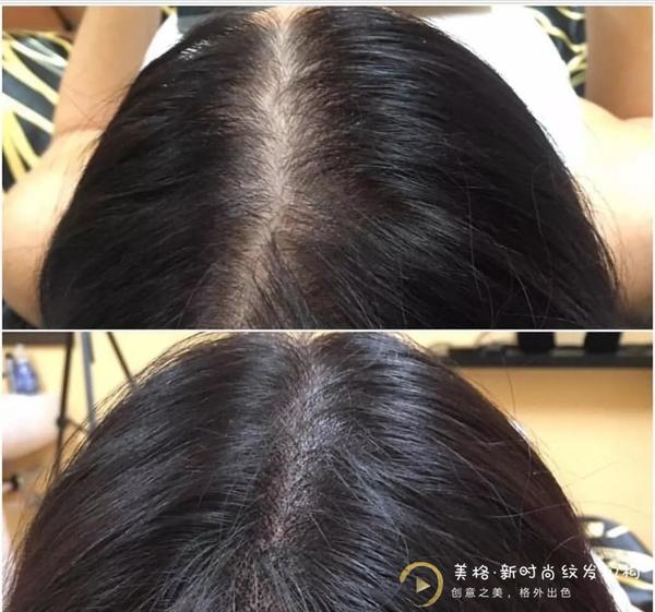 女性脱发