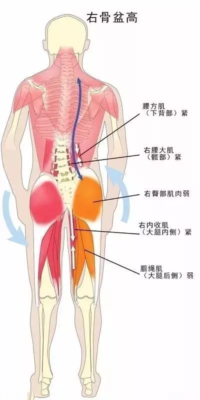 骨盆倾斜 可能原因:长短腿,腰方肌和背阔肌过度收缩;单侧的髂骨前旋