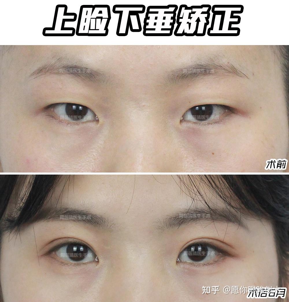 肿泡眼一个单眼皮一个内双怎么选择合适的项目