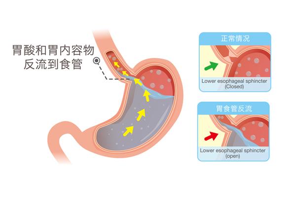 反流性食管炎的 典型症状是酸性液体从胃食管反流到咽部或口腔,以及