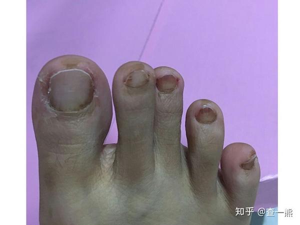 过程记录: 图一:大脚趾的趾甲前端增厚很明显,其他趾甲都有发白的
