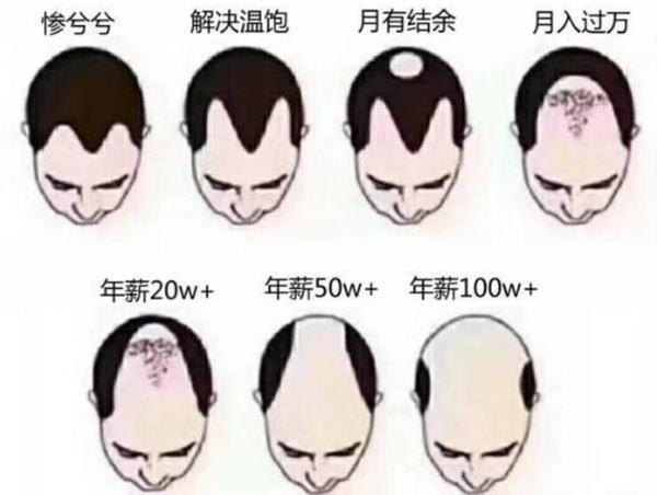 秃顶,是男人最终的宿命?