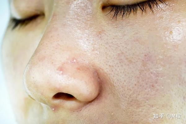 40岁以上女性如何改善预防皮肤出油
