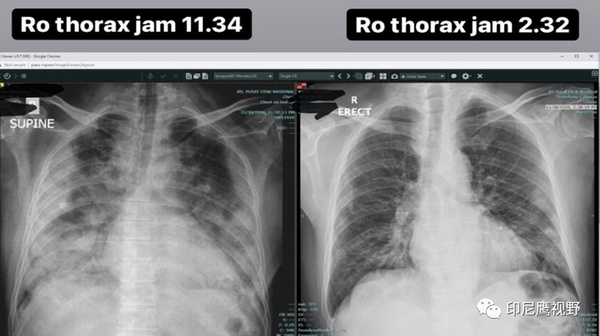 印尼新冠患者9小时内肺部x光变化令人震惊