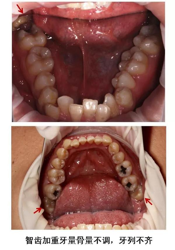 当智齿没有足够空间生长,脱离"轨道",与邻牙之间产生缝隙,容易嵌塞