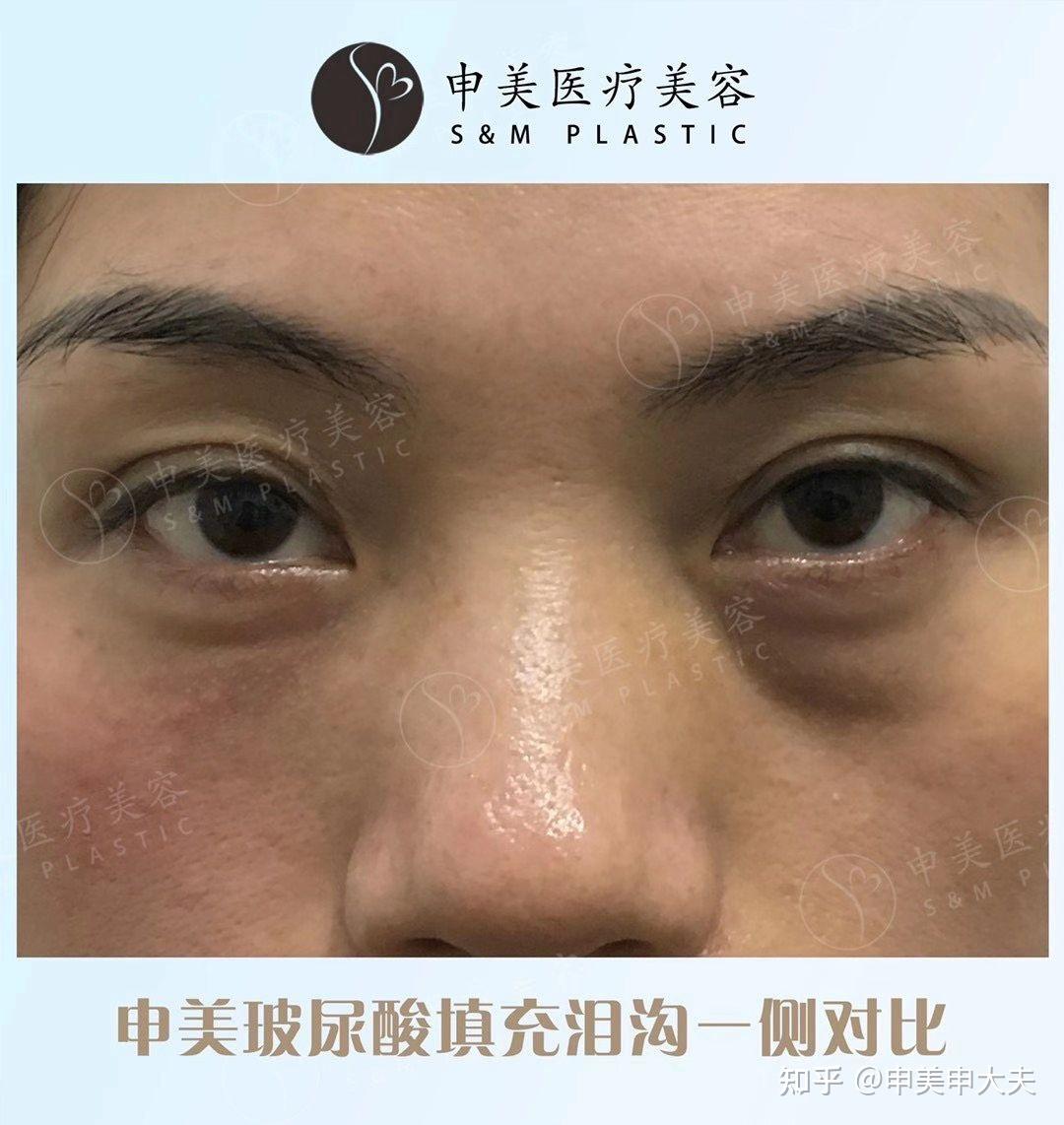 天生眼袋有泪沟嘛我要怎么搞哦19岁谢谢谢谢