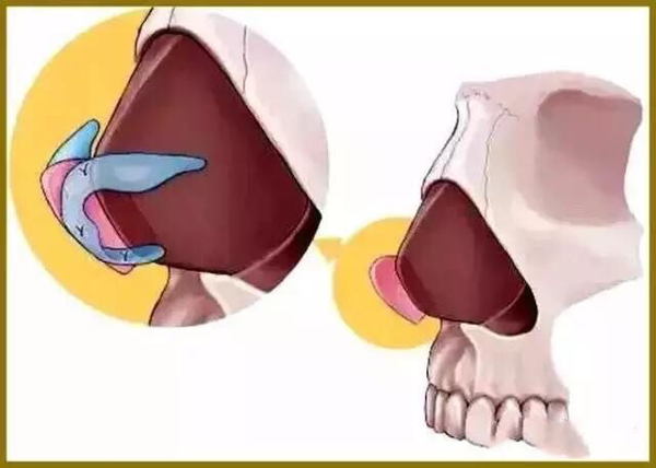 鼻中隔切除或移植的话,就如下图啦 取出的鼻中隔尾侧软骨,可以缩小鼻