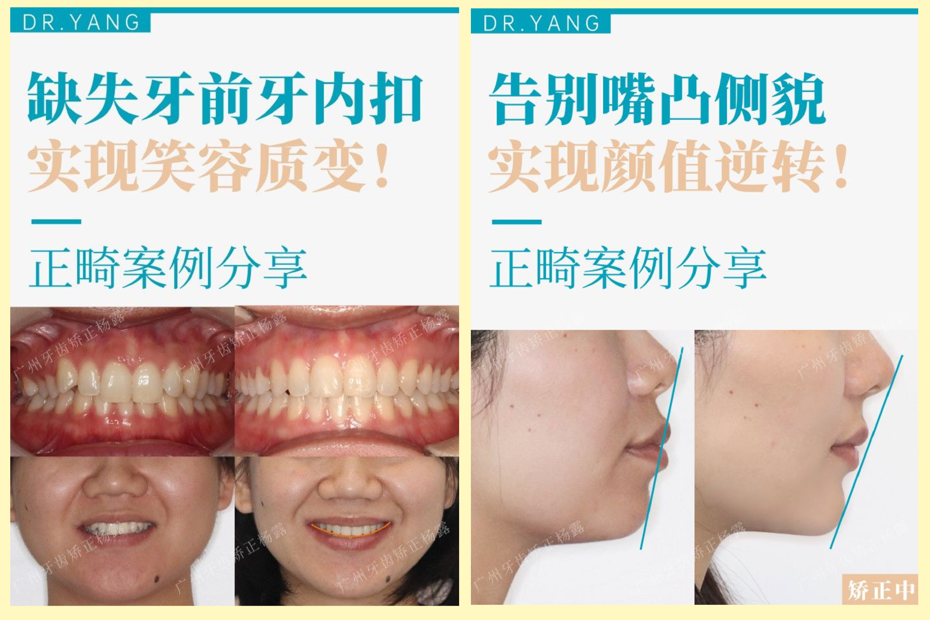 广州牙齿矫正医生∣杨露院长高标准高追求成就自己成就门诊