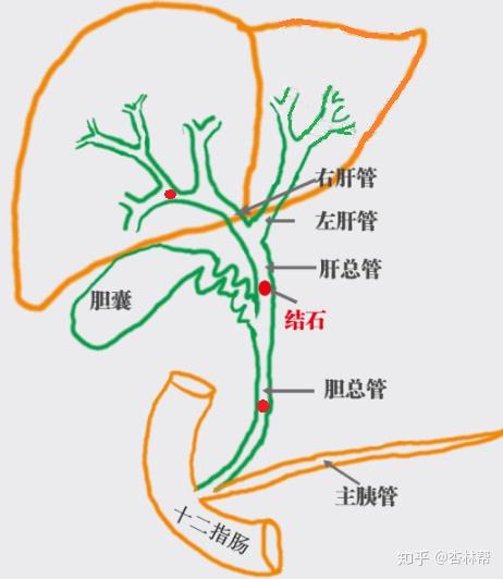 名医专访北京大学第一医院田孝东胆管结石应该如何治疗