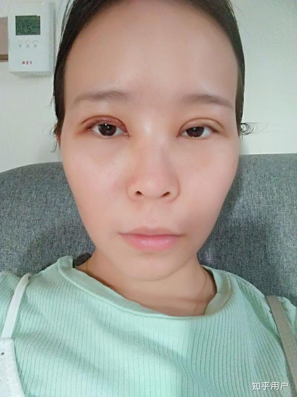 恢复了两三天 因为一个星期不能洗脸洗头所以有些憔悴