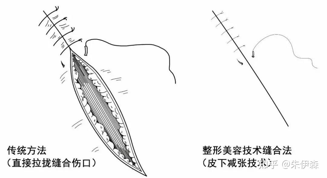 此类外科医生一般未经整形美容科专科培训,急诊清创的目的在于止血