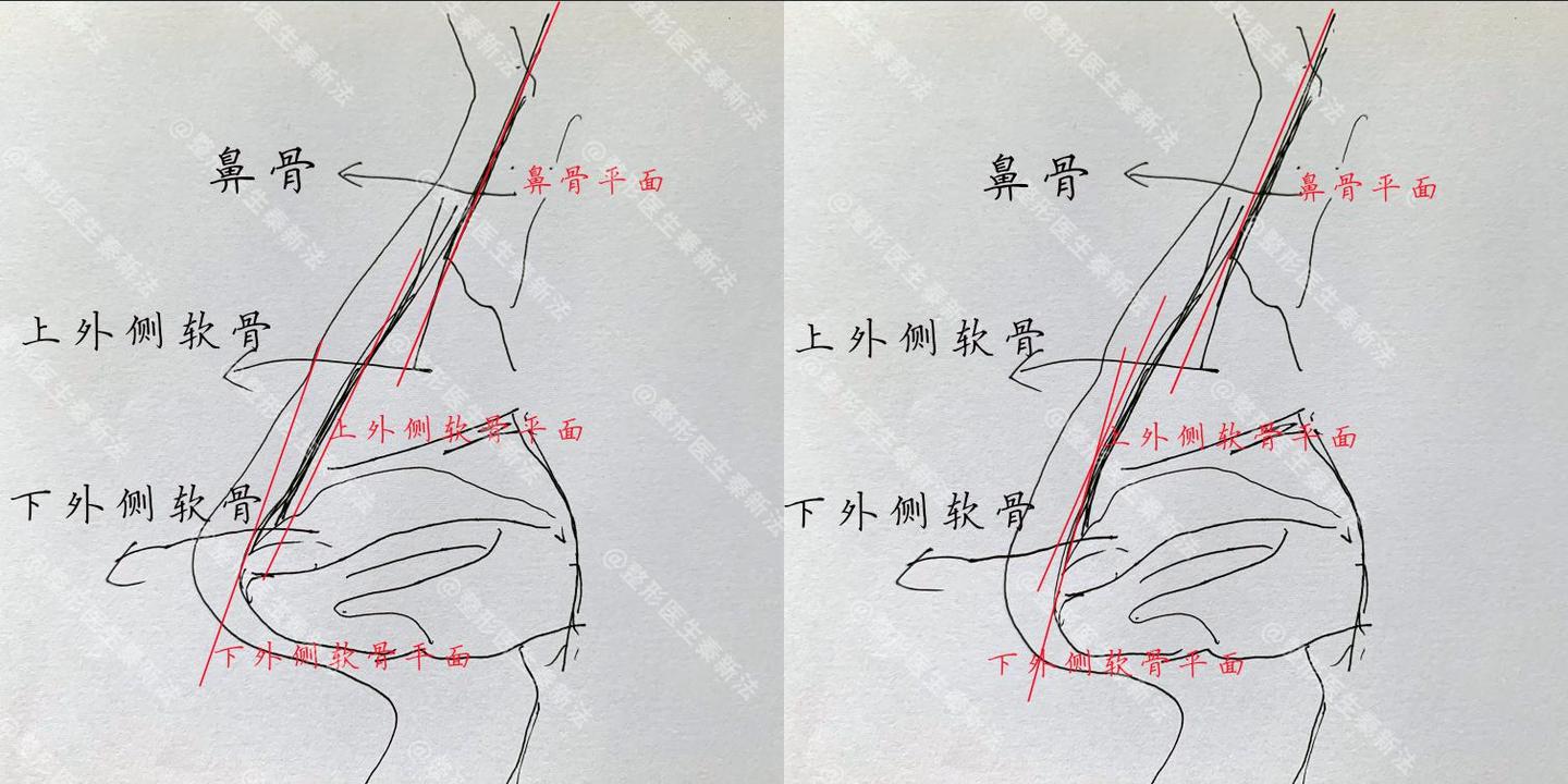 鼻头大可能是因为鼻头脂肪太多剖析鼻尖脂肪垫结构