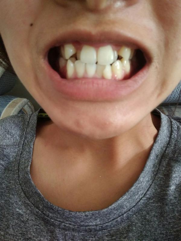 这种牙齿不拔牙有效吗?