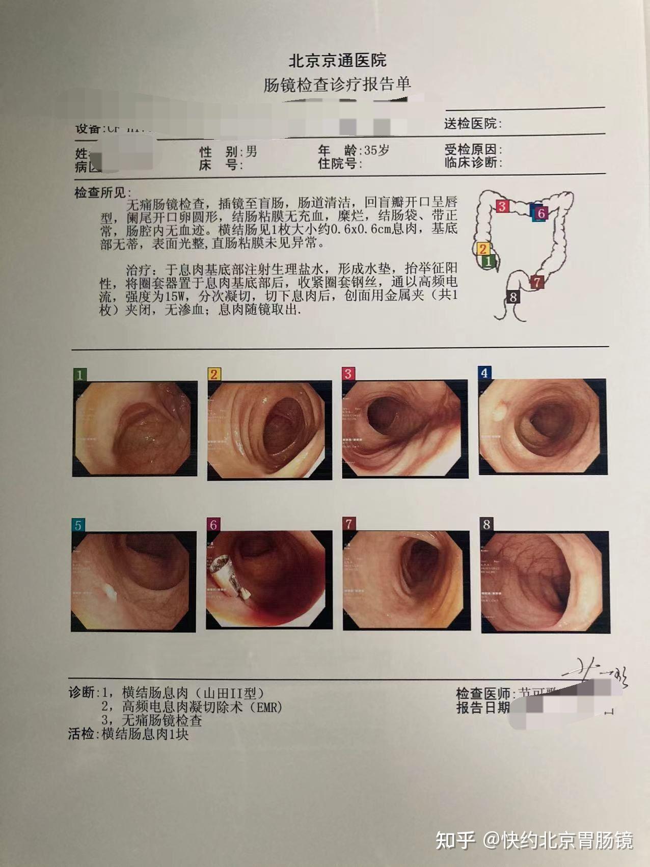 肠息肉总会在没有任何症状下生长