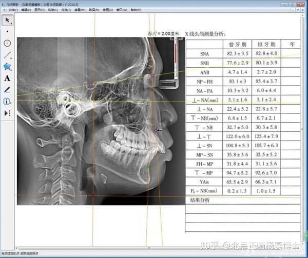 北京正畸杨磊博士:什么是头影测量片,什么是头影测量分析?