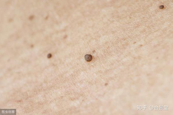 皮肤长小肉疙瘩是咋回事?医生:最常见的是这3种,问题可轻可重