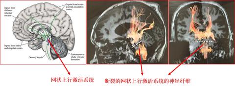 董月青:脑干出血为什么会导致昏迷不醒? zhuanlan.zhihu.com