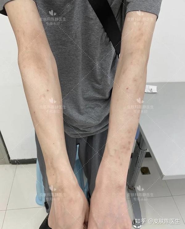 在儿童阶段,容易出现在肘窝,膕窝,俗称"四弯风"(如下图) 到了成人