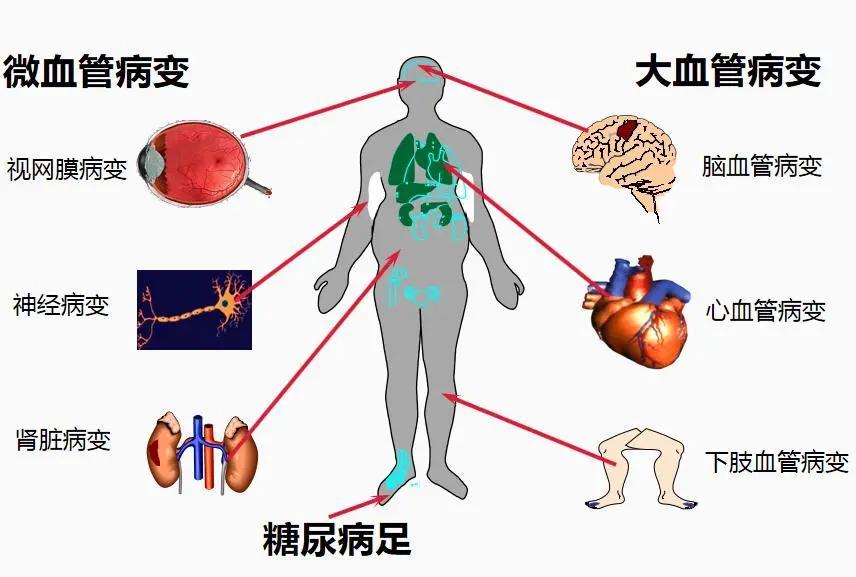 原来糖尿病是这样伤害血管的华之康带你1分钟自测血管好坏