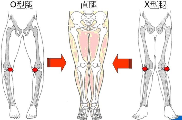 笔直大长腿o型腿追本溯源对症下药篇