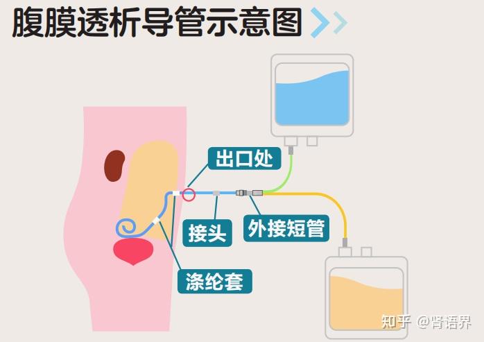 肾语小故事丨家庭透析③,腹膜透析置管