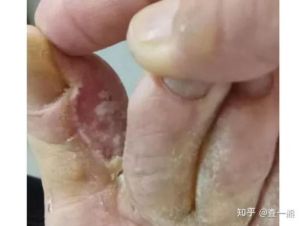 糜烂型脚气多年足菌缠扰糜烂都难以上课