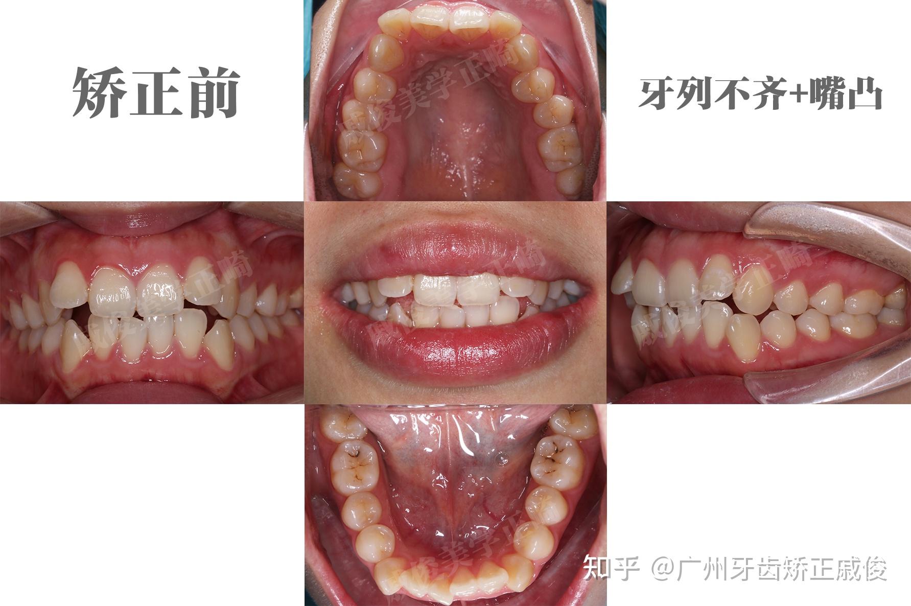 广州牙齿矫正下巴后缩竟是关节病变