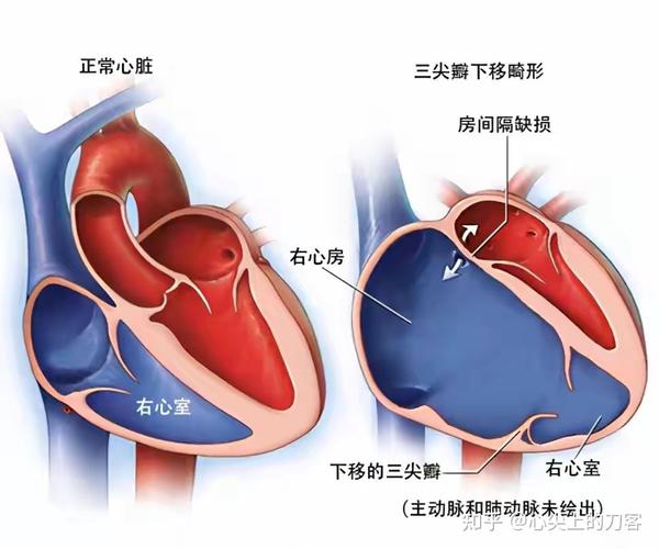 三尖瓣下移畸形