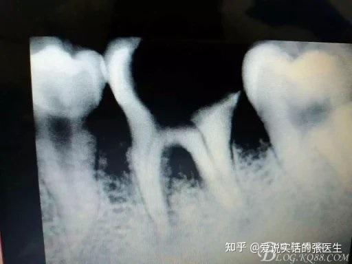 所以我们会采用膜龈手术增宽附着龈宽度