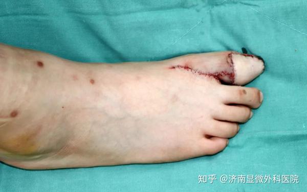 全形再造术后 术后脚部