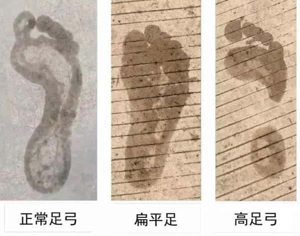 足弓在运动中的维持因素是什么要怎么锻炼来加强足弓