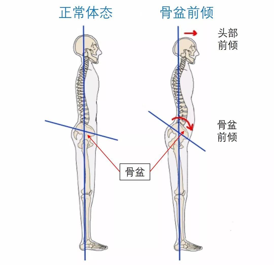 骨盆前倾背后的真相