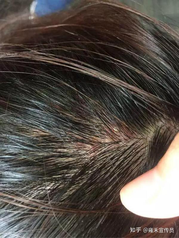 如果出现下列变化则要留意是不是脂溢性皮炎: 1,头皮屑增多伴有瘙痒