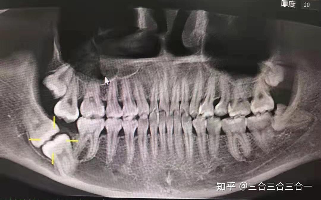 有朋友智齿这样长的吗