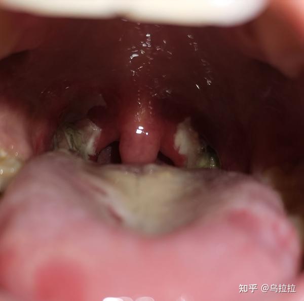 扁桃体反复发炎化脓17岁扁桃体切除感受