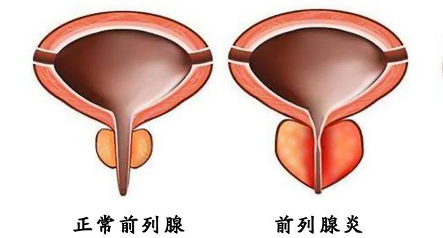 男人远离前列腺炎从改正这10个不良生活习惯开始