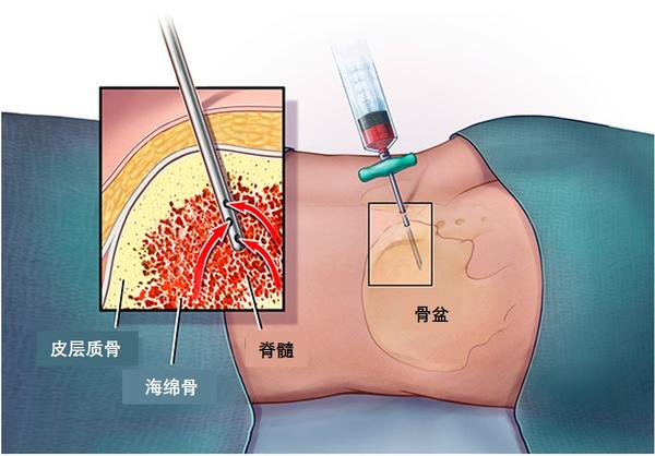 穿刺活检会引起癌症扩散或转移吗?