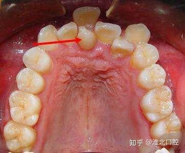 有些牙齿在生长过程中由于各种原因造成错位或排列不齐,很容易造成