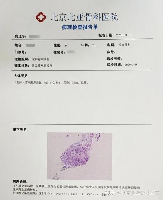 【北亚技术科普】超声引导下穿刺活检术!